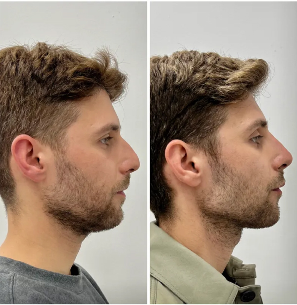 dr-christian-zapata-armonizacion-facial-2