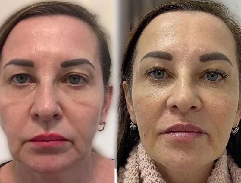 dr-christian-zapata-Cómo-rejuvenecer-sin-perder-tu-esencia-armonizacion-facial-3